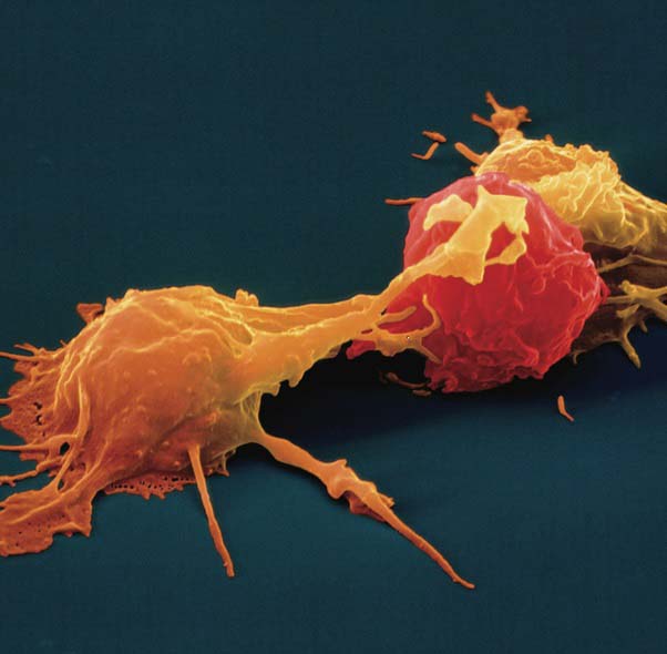Tại sao hệ miễn dịch không thể chữa trị ung thư?